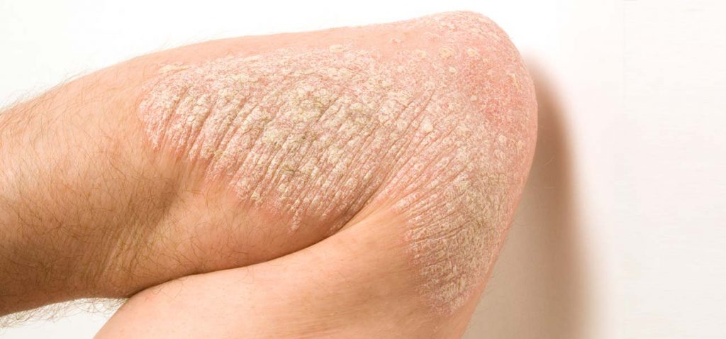 Aknebehandling uden antibiotika