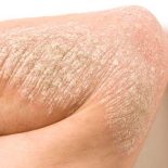Aknebehandling uden antibiotika
