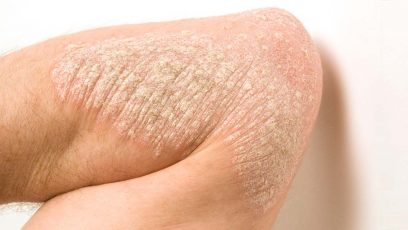 Aknebehandling uden antibiotika