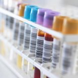 Non-invasive retinale markører ved diabetisk retinopati – fra forskning til evidensbaseret behandling