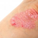 Biologisk Behandling Af Psoriasis