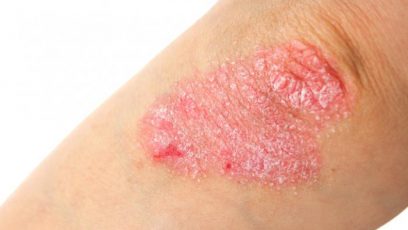 Biologisk Behandling Af Psoriasis