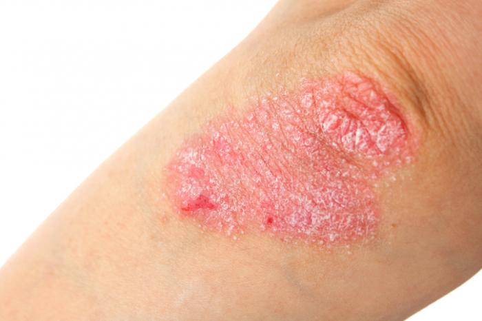 Biologisk Behandling Af Psoriasis