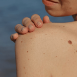 Færre skoldninger vil reducere forekomsten af hudkræft